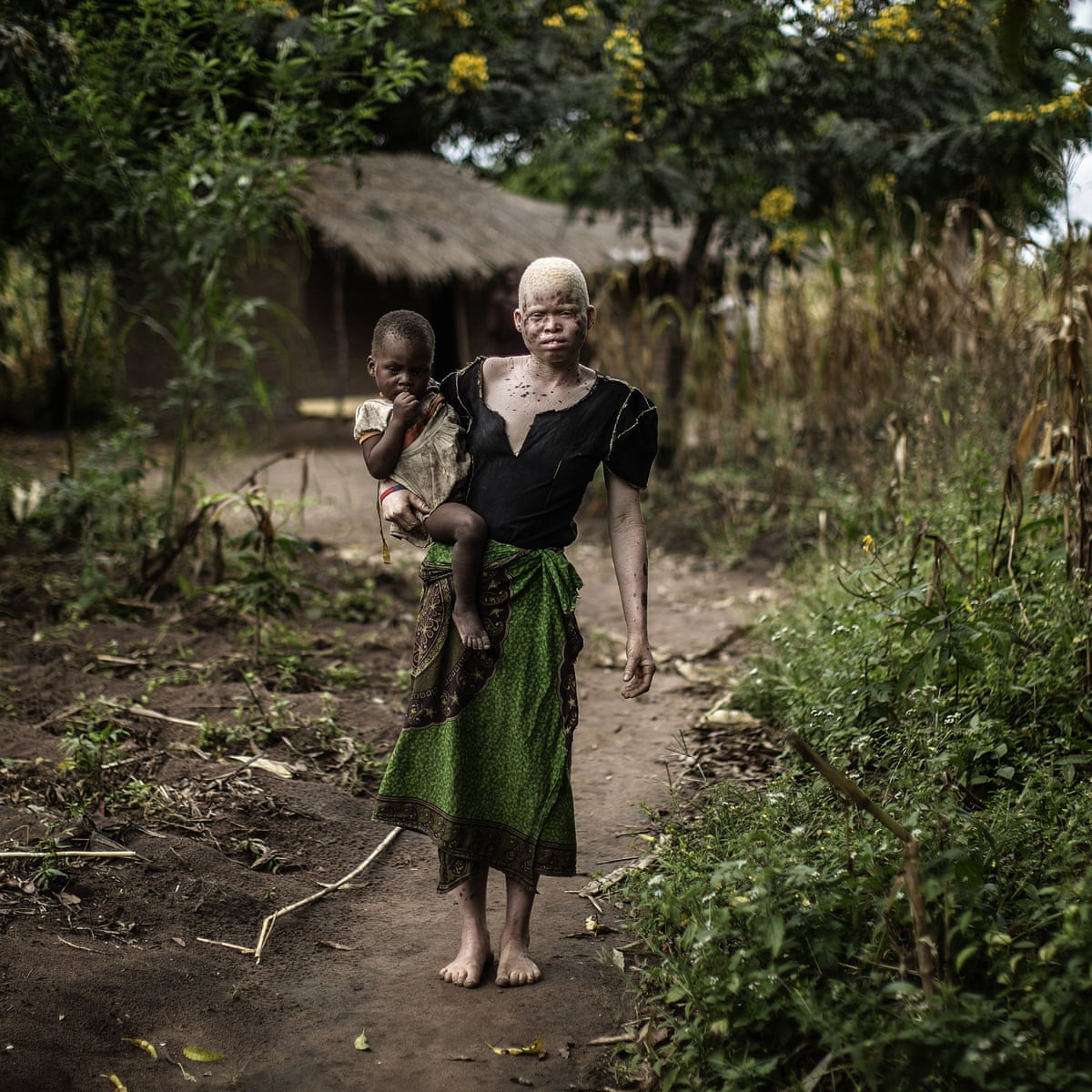 We live in fear because of our skin': Malawians with albinism demand action to reduce cancer risk | Albinism | The Guardian