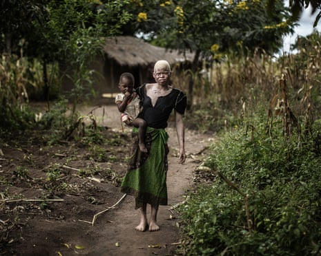 A Malawian woman with albinism in rural Nkole, Machinga district, April 2015