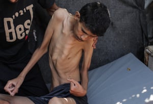 A 25-year-old Palestinian is visibly severely malnourished
