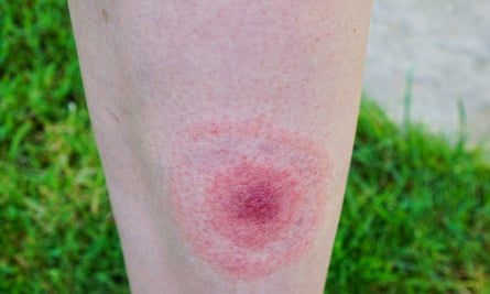 The distinctive “bullseye” marking caused by a bite from a deer tick.
