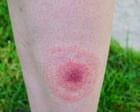 Lyme disease cases in England rise by more than 20% in a year