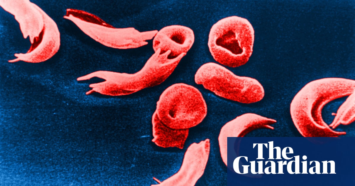 Sickle cell disease patients feel neglected by NHS England, report says