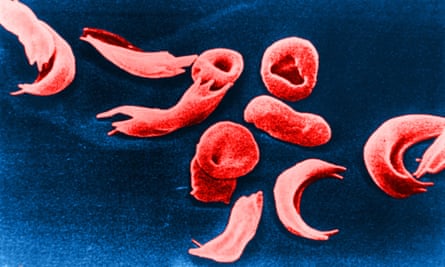 a scanning electron microscope image of red blood cells affected by sickle cell disease