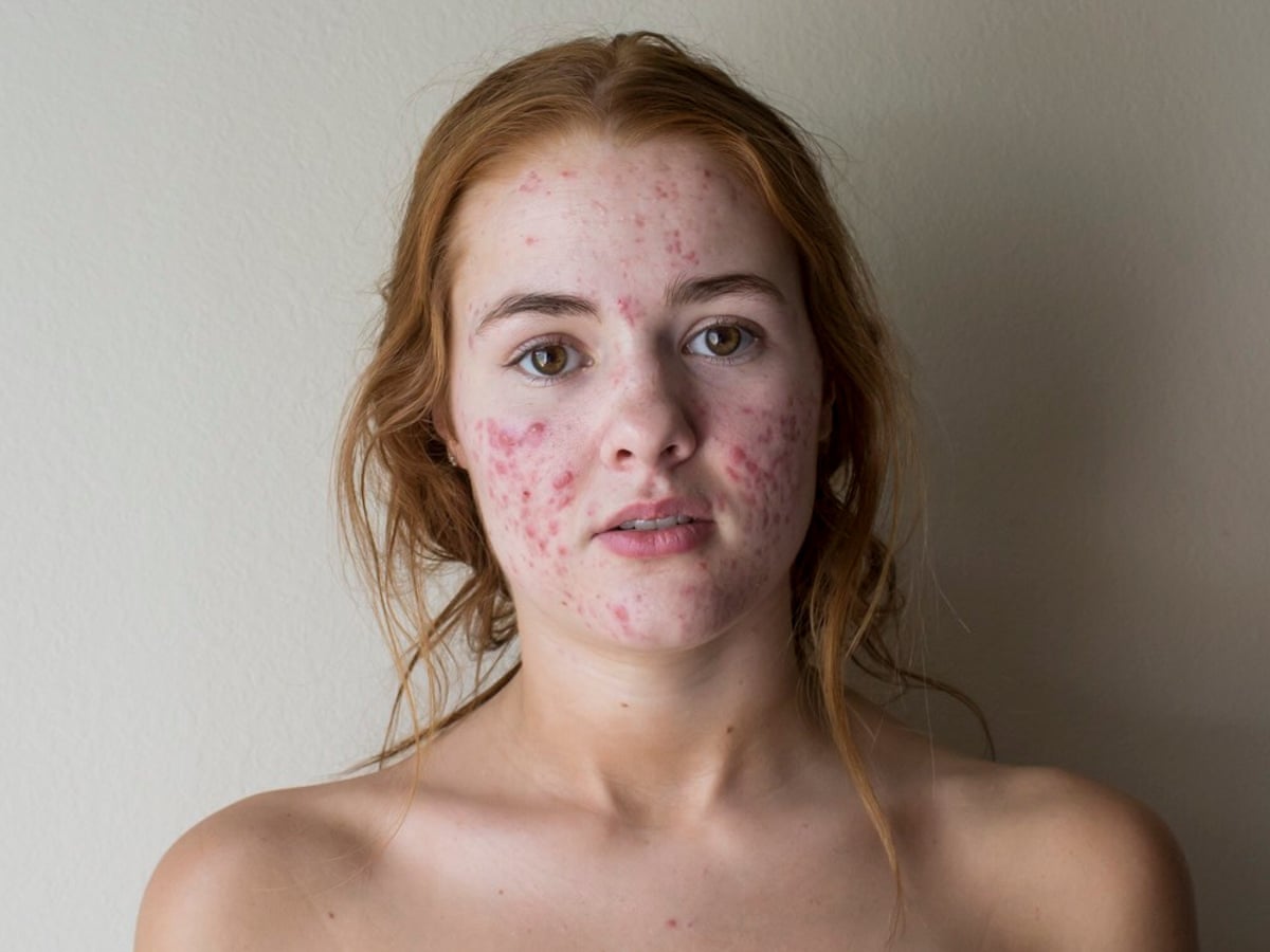Pimples Are In The Rise Of The Acne Positivity Movement Skincare The Guardian