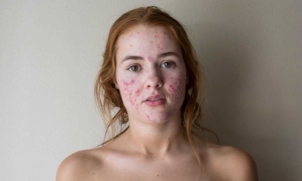 Pimples Are In The Rise Of The Acne Positivity Movement Fashion The Guardian