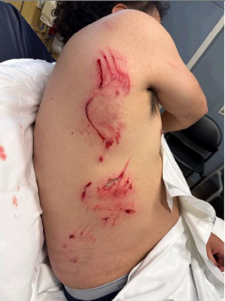 A man shows dog bite injuries to his torso.,