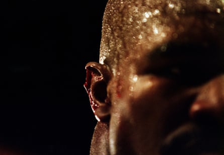 A close-up of the injury to the right ear of Evander Holyfield of the USA after Mike Tyson Of the USA bit off a piece of it in the third round of their World Heavweight title fight on June 28, 1997 at the MGM Grand Garden in Las Vegas, Nevada, USA