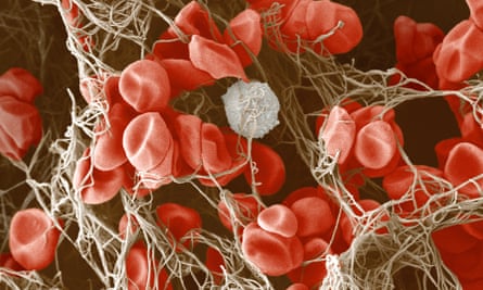 Science and nature… a scan showing the formation of a type of blood clot that can give rise to acute myeloid leukemia.