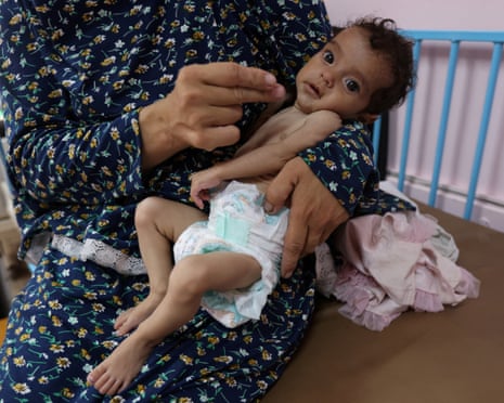 Woman holds very thin baby