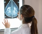 AI can detect heart disease in women using mammograms, study suggests
