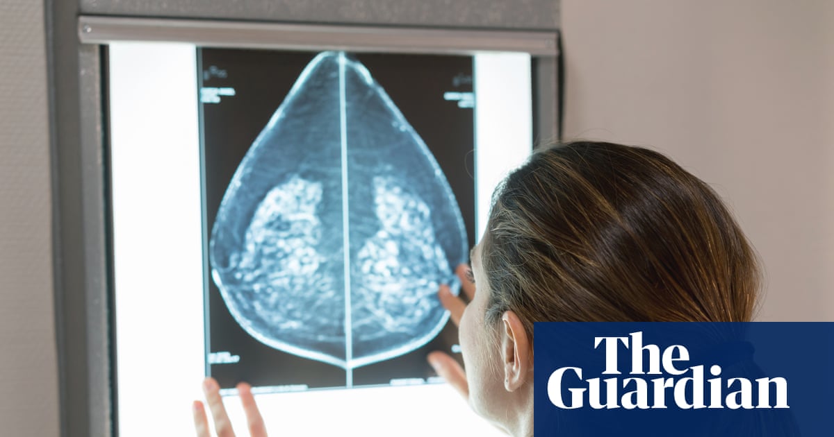 AI can detect heart disease in women using mammograms, study suggests