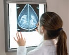AI can detect heart disease in women using mammograms, study suggests
