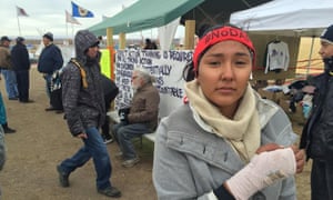 Lauren Howland, with broken wrist suffered at the pipeline protest.