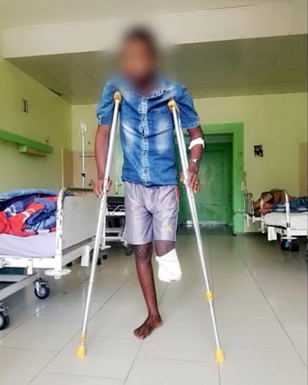A man in a hospital on crutches. His left leg is amputated below the knee