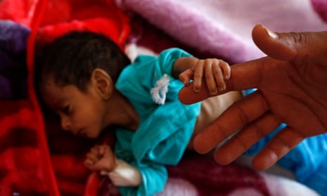 A malnourished child holds his father’s finger as he receives treatment at a hospital in Sana’a, Yemen.