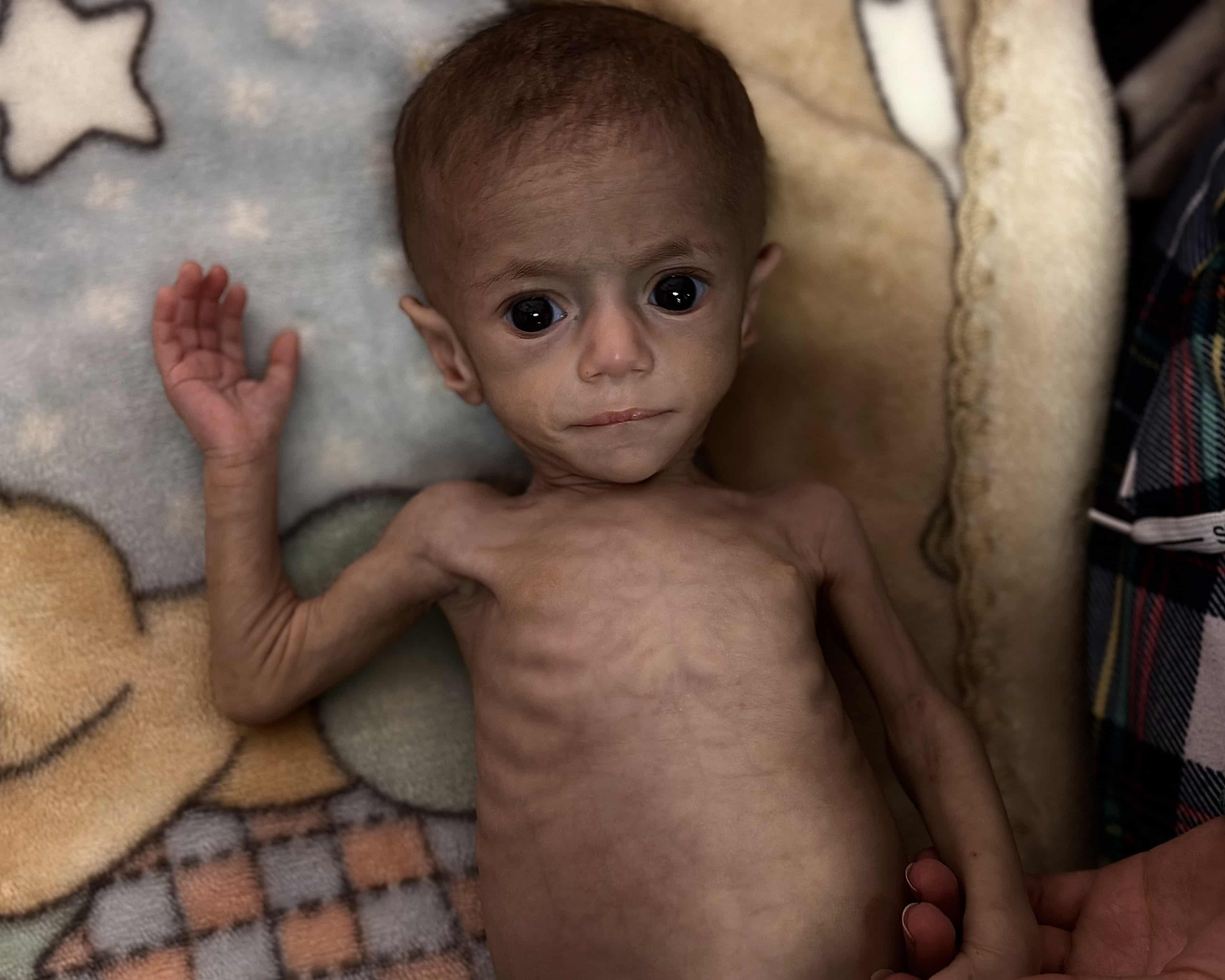 Baby Siwar Ashour suffers in Gaza in May, 2025