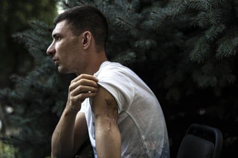 A Ukrainian man at a refugee camp in Dnipro shows his injured arm.