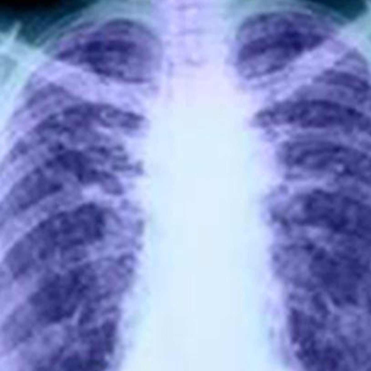 how long do you hold cigarette smoke in your lungs Have ever wondered what smoking actually does to lungs? A healthy lung, like those from a non-smoker, is pink, spongy, and full of air sacs that let oxygen pass into The Difference Between Healthy Lungs