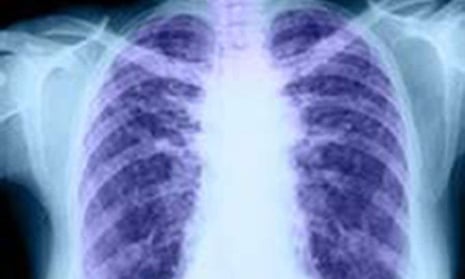 An X-ray of healthy lungs