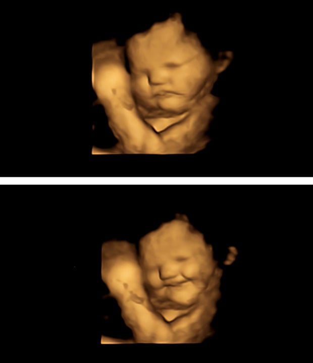 imagens de ultra-som 4D de um feto