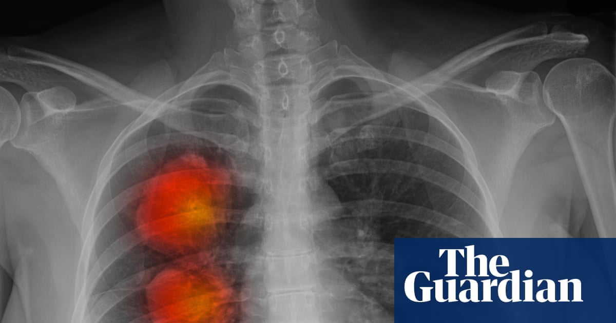 More than 60,000 cancer patients in England not getting necessary radiotherapy'