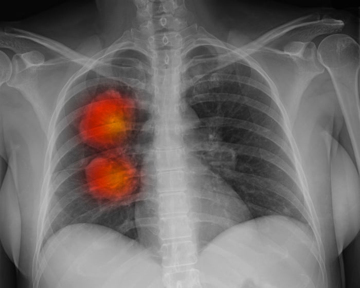 More than 60,000 cancer patients in England ‘not getting necessary radiotherapy’
