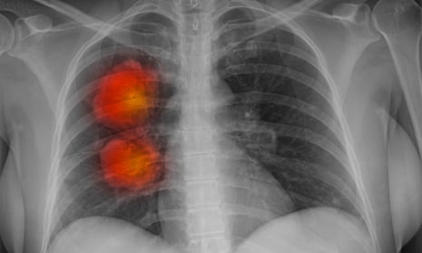 x-ray of lung with red blobs