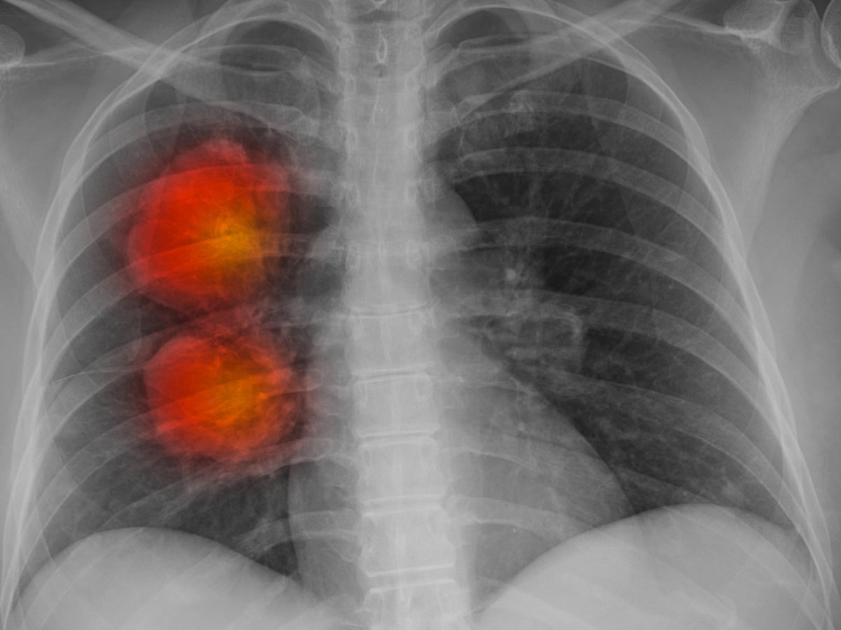 New artificial intelligence tool can accurately identify cancer | Cancer | The Guardian