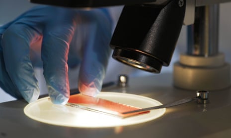 A medical scientist studying a blood sample under microscope