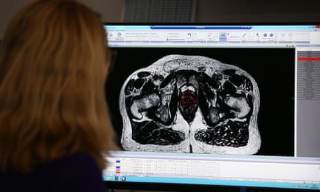 An oncologist at the Royal Marsden hospital in Surrey analyses an image of man’s prostate gland.