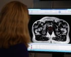 More than 60,000 cancer patients in England not getting any radiotherapy, research shows