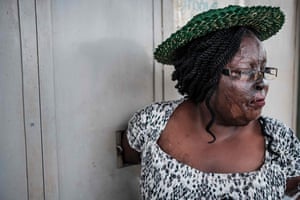 Jennifer Mutesi had acid poured over her face in 2011 by a co-worker who was jealous of her success. She lost sight in one eye; she remembers that as the acid was burning her, people in the streets were filming the situation with their mobile phones rather than helping her. After a long recovery and trauma, she now owns a small bar and makes enough money to support her four children.