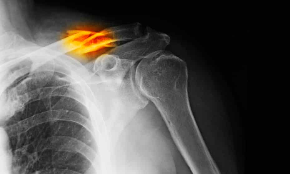 x-ray showing a clavicle fracture