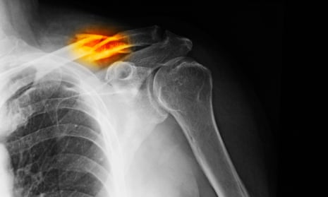 x-ray showing a clavicle fracture