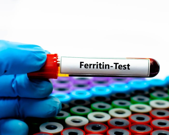 ‘Ferritin face’: are social media claims about iron deficiency fact – or fiction?