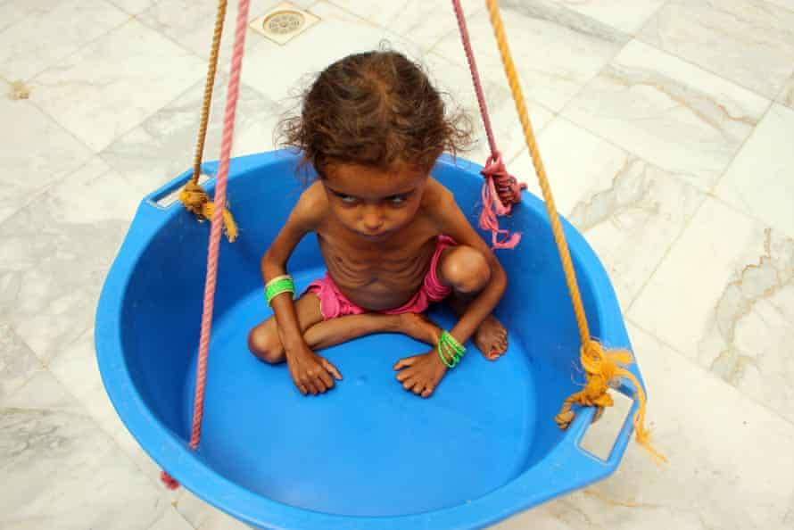 A girl suffering from malnutrition is weighed at a clinic in Yemen’s northern Hajjah province.