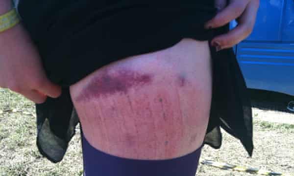 La jambe Glastonbury de Laura, avec une ecchymose violette