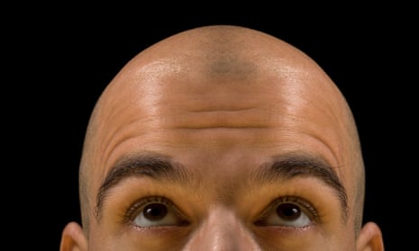 A bald man looking up at his scalp