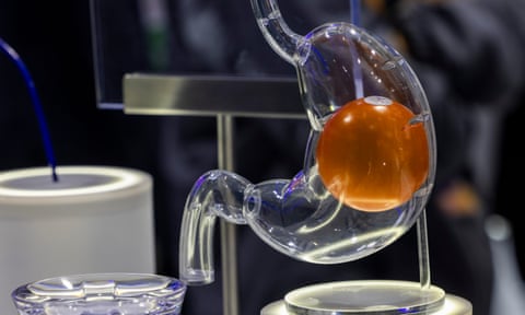 Mô hình thủy tinh tái tạo dạ dày của con người với một quả bóng dạ dày bên trong