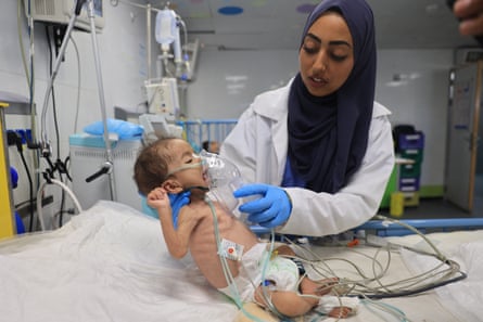 Skeletal baby with nurse in hospital