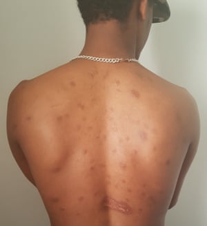 A victim of Medhanie Mered, an Eritrean smuggler, shows the scars from injuries inflicted by traffickers to whom Mered sold him.
