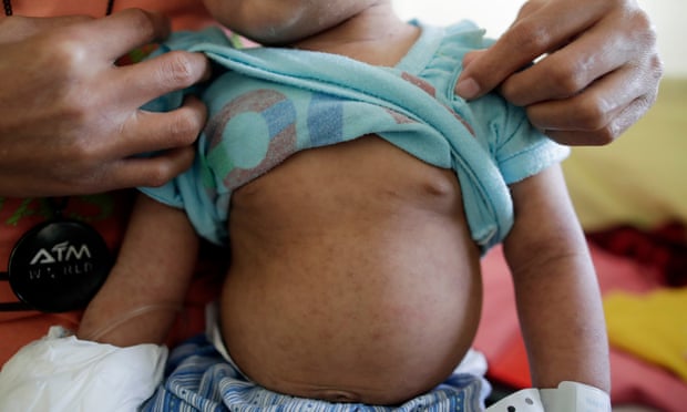 A child suffering from measles is treated at a government hospital in Manila, the capital of the Philippines