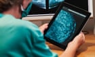 Predictive blood test hailed as ‘incredibly exciting’ breast cancer breakthrough