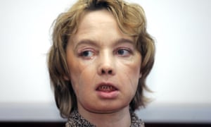 Isabelle Dinoire, who underwent the world’s first partial transplant