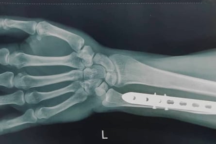 X-ray of a metal plate in Abbas’s arm