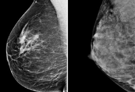 side by side mammogram images