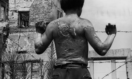 Kiyoshi Yoshikawa, a survivor of the atomic bombing of Hiroshima in 1945, displays the heavy scarring on his back, soon after leaving hospital, on 13 August 1951.