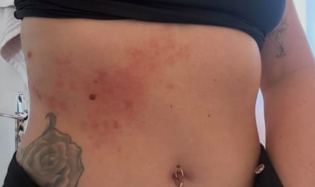 Midriff with a red rash