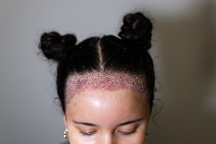 Headshot of a woman with hair tied up in buns either side of her head and a red strip across her forehead, below her hairline, where she’s had a hair transplant