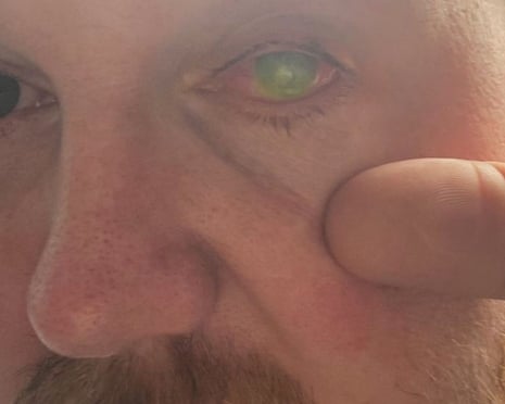 Paul Laskey holds his left eye wide open to show its condition after treatment